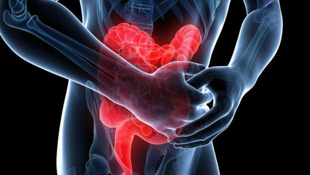 Colite ulcerosa e malattia di Crohn