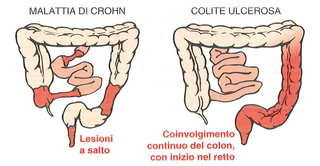 malattia di Crohn
