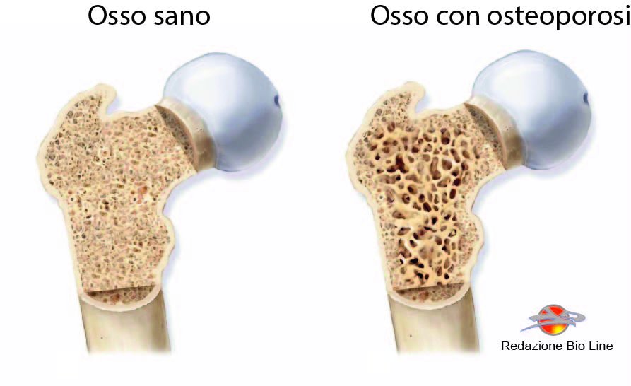 osteoporosi
