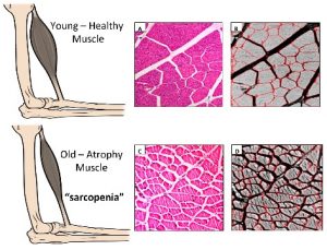 Invecchiamento e sarcopenia