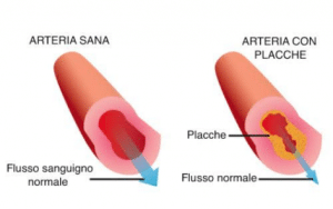 Arteria sana vs arteria con placche